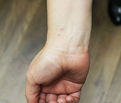 Melissa Salazar displays her right arm, two small scars remaining after a radial artery technique