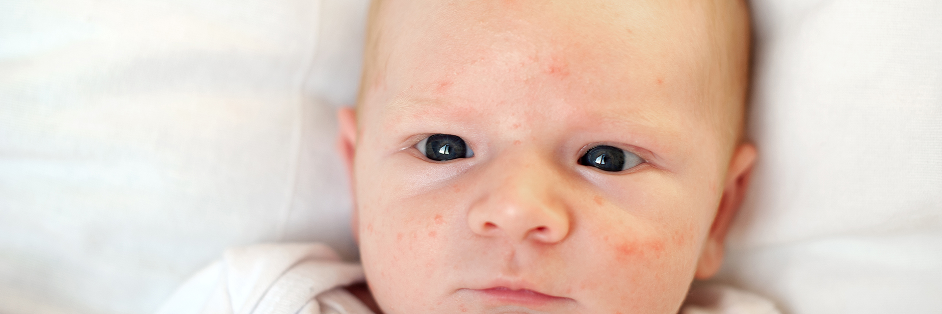 Baby with pimples